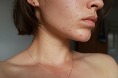 Mitől alakulhat ki pattanás felnőttkorban? Ilyen, ha hormonzavar okozza