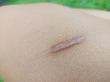 Keloid