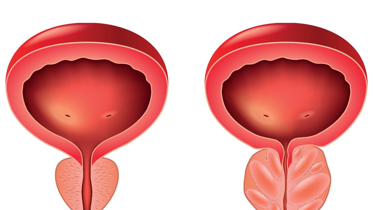 kezelés otthoni prostatitis