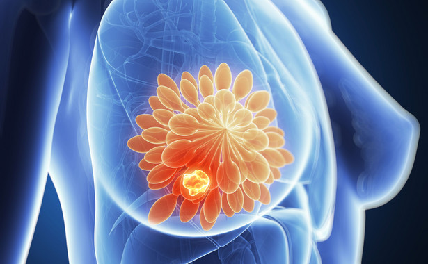 Nowy, przełomowy lek na agresywnego raka piersi