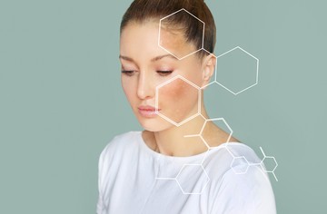 májfolt, bőrfolt, hormonális problémák, hormonzavar
