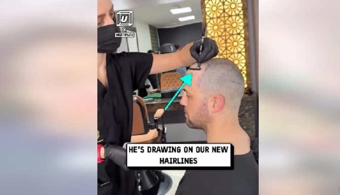 Markiranje problematičnih delova pred transplantaciju kose 