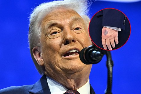 Czy Donald Trump jest chory? Nowe zdjęcia wywołały falę spekulacji o stanie zdrowia