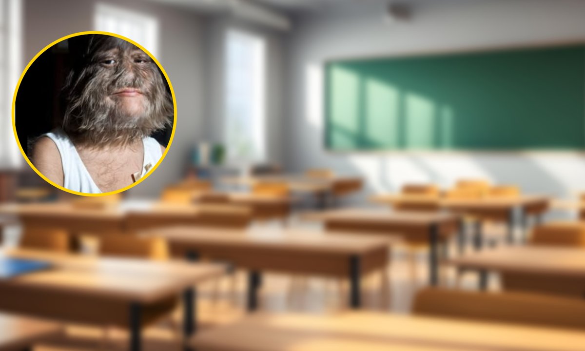 Była "najbardziej owłosioną nastolatką świata". "Nie czuję się inna niż inni"