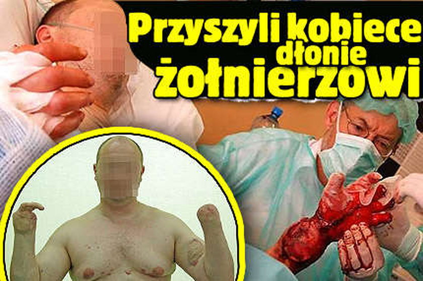 Przyszyli kobiece dłonie żołnierzowi !