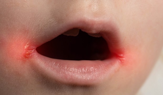 Impetigo na licu najpre počinje oko usta i nosa