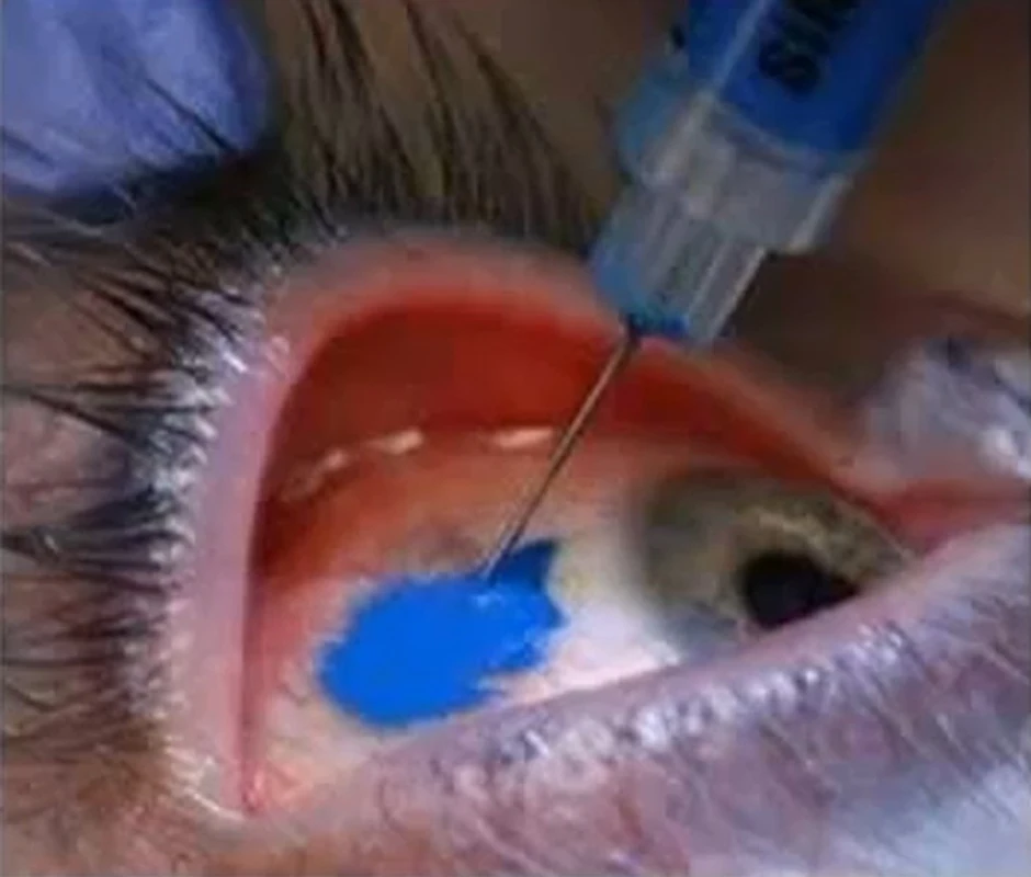 Plave oči - bukvalno