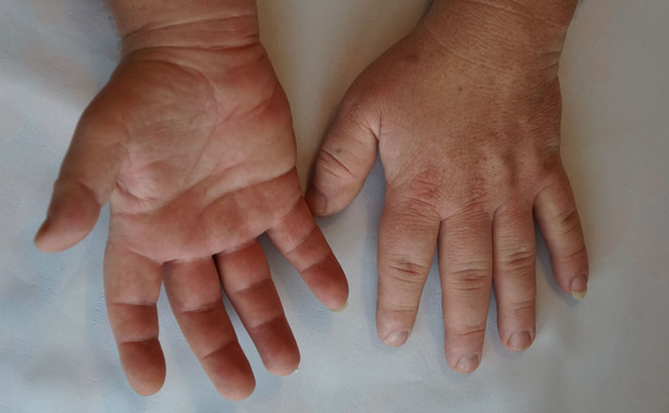 Akromegalia, dłonie