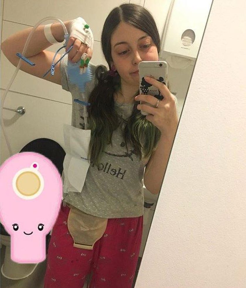 Bethany Purnell miała chorobę Crohna. Dziś pozuje z ileostomią