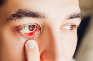 belső árpa tünete kezelése szemen szemárpa tünetei