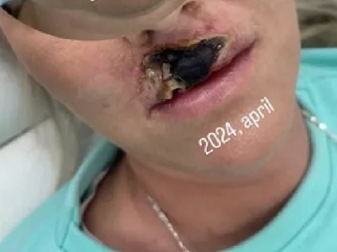 Otišla na korekciju usana na neproverenom mestu i dobila nekrozu na licu