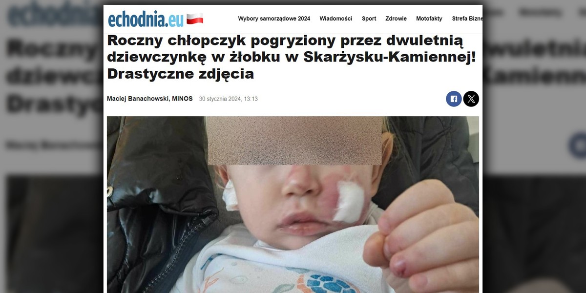 Mały Antoś został dotkliwie pogryziony przez koleżankę. 