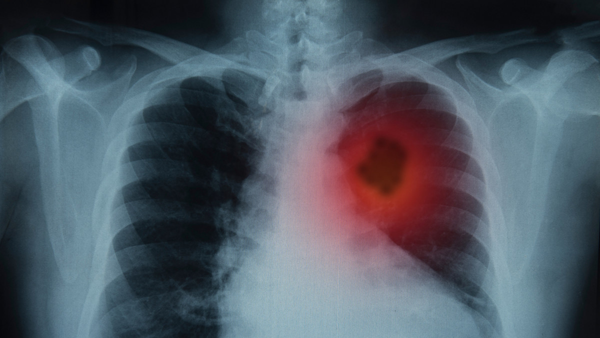 Chorzy na raka płuca w najwyższej grupie ryzyka zakażenia koronawirusem. Ten nowotwór coraz częstszy w Polsce