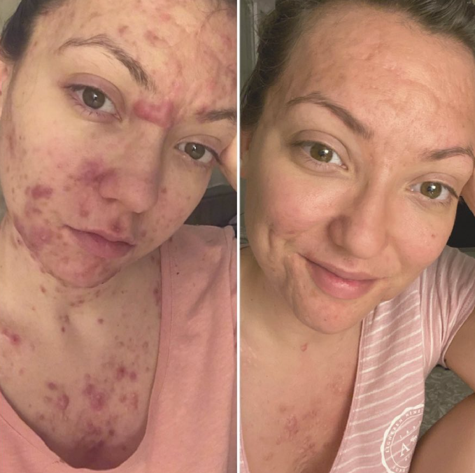 Mandy Nazé strpčovalo život akné. 