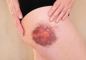 Hematom u glavi se generalno smatra ozbiljnijim nego hematom u drugim delovima tela