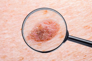 bőrrák, basalioma, karcióma, solaris keratosis