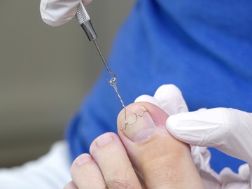 A körömdeformitások és a körömlemez egyéb ok miatti megvastagodásai szintén eredményezhetnek benőtt körmöt - az ilyesmi által kiváltott probléma gyakoribb férfiaknál.