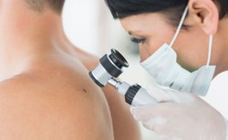 Poparzenia słoneczne znacząco zwiększają ryzyko czerniaka. Jak temu zapobiec?