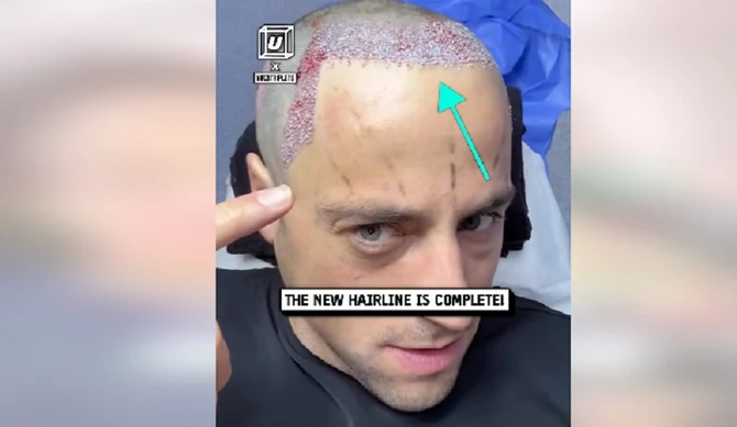 Braća otišla u Tursku po novu kosu pa javno prikazali to iskustvo