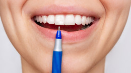 Skąd się biorą białe plamy na zębach? Dentystka wymienia przyczyny