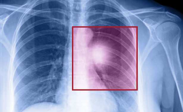 Coraz więcej przypadków raka płuc u niepalących. Ekspert: Powodem zanieczyszczone powietrze