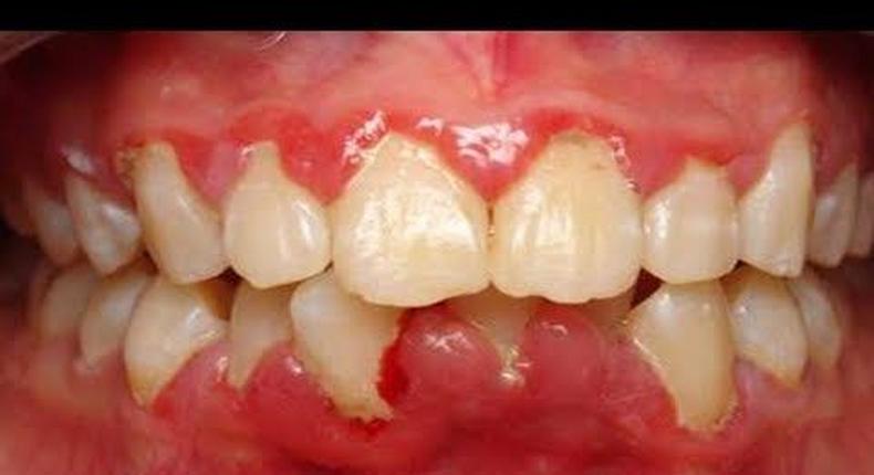 3 home remedies to get rid of gingivitis. [pinterest]