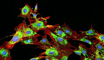 áttétes daganat, tumor, áttét, rák terjedése