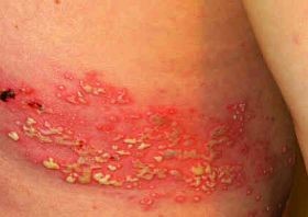 herpes-zoster-ovsomor-d00000EF8adf1bc4350ec