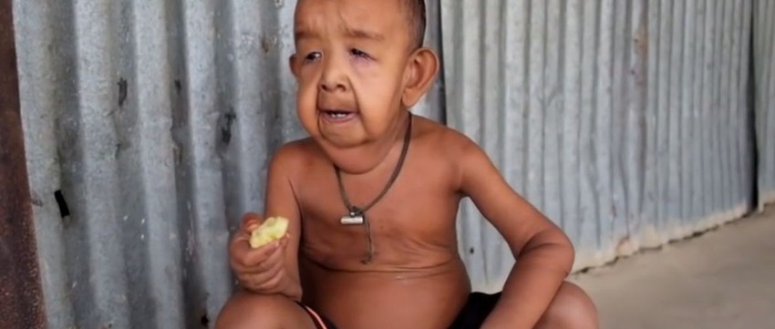 Dečak oboleo od retke bolesti izgleda kao starac