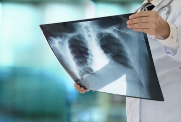 Tüdőgyulladás: változatos és néha furcsa tünetekkel is járhat