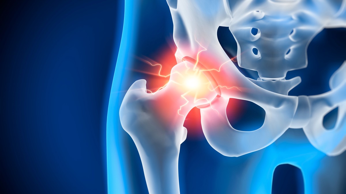 Ultra prerađena hrana slabi kosti i povećava rizik od preloma kuka