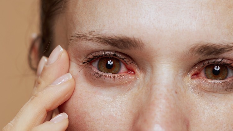 szemviszketés duzzadt szem gyulladás allergia pollen