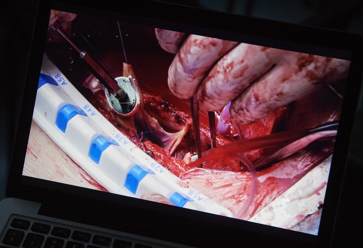 WSZCZEPIENIE PIERŚCIENIA HAART DO SERCA