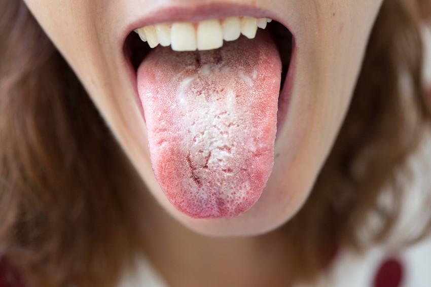 Of course, oral thrush can be caused not only by Candida albicans, but also by other Candida species (such as Candida tropical, Candida glabrata, Candida krusei, etc.), and it is also possible that completely different fungi are behind the infection.