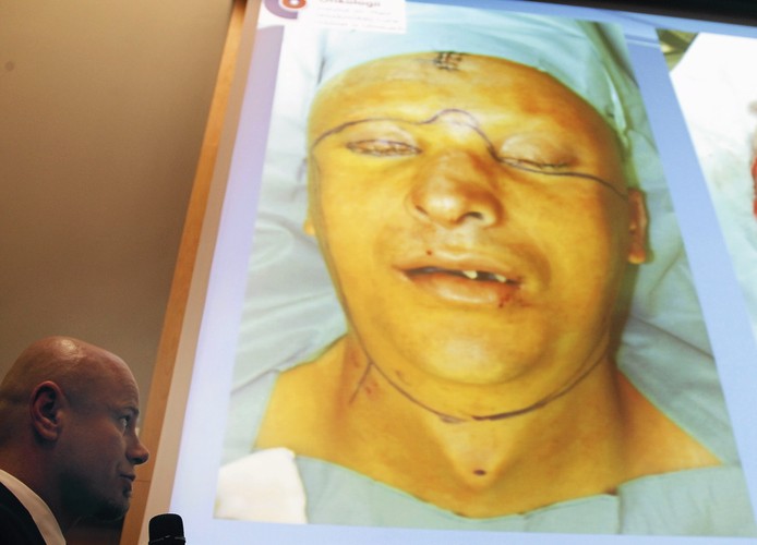 Pierwszy w Polsce przeszczep twarzy