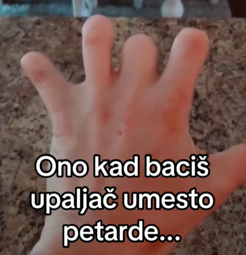 Miloš je ostao bez svih pet prstiju zbog petarde