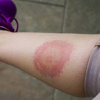 Lyme-kór: így zajlik a kullancsok által terjesztett betegség kezelése