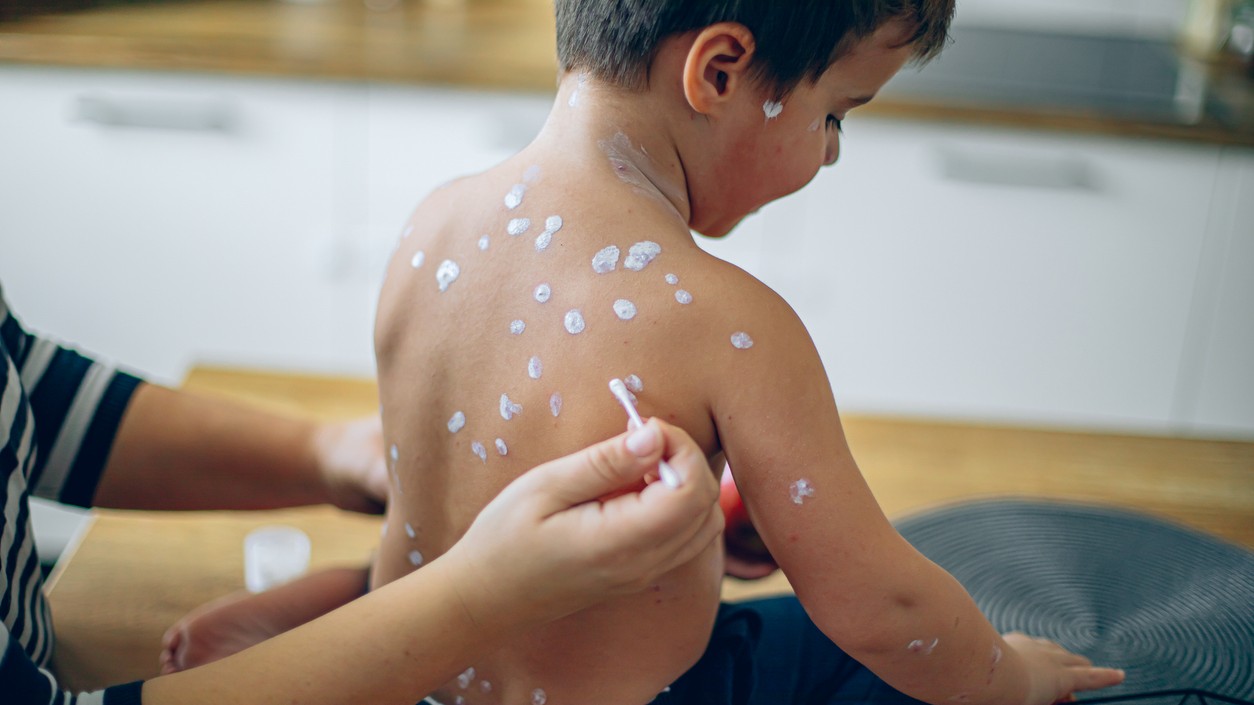 Vírus osýpok sa šíri do viacerých krajín. (ilustračné foto)