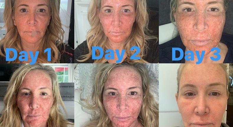 RHOC' Shannon Beador Just Shared Photos Of Her Skin Recovering From CO2  Laser Treatment | Pulse Nigeria