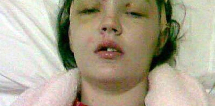 Obudziła się w szpitalu bez czoła. Kolanami zmiażdżyła sobie twarz!