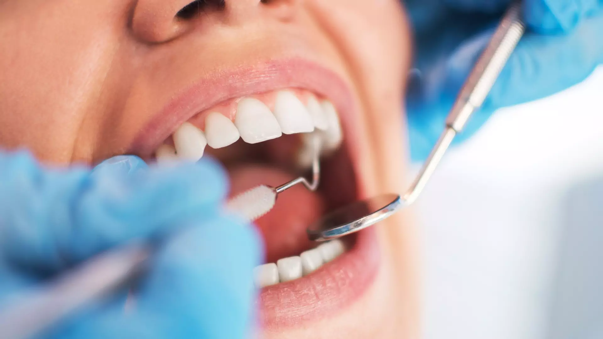 Kamień na zębach – przyczyny, jak usunąć, jak zapobiegać?