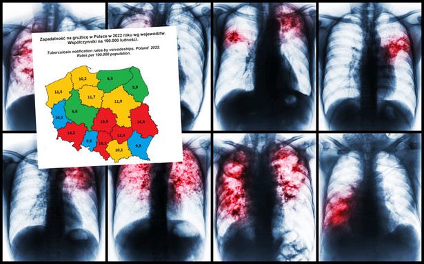 Wraca zapomniana choroba, do Polski także