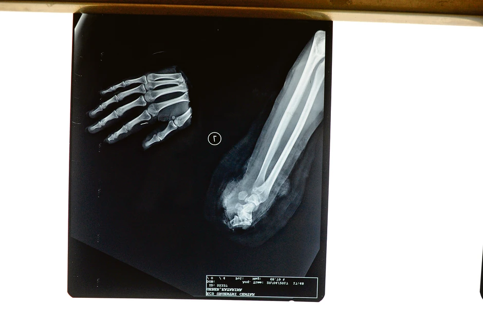 Mašina je Katarini odsekla ruku gotovo ravno, pod pravim uglom.