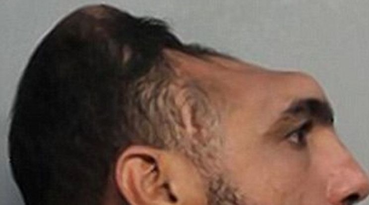 A "feles" becenévre hallgató férfi balesetben vesztett el agyának egy részét /Fotó: Miami police