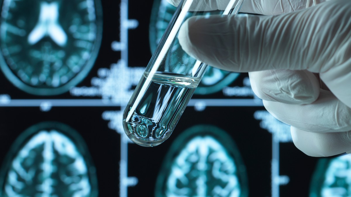 Az Alzheimer-kór öt altípusának azonosítása óriási hatással van a kezelésre