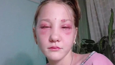 Masha Kuznetsova, rosyjska nastolatka została poparzona i częściowo oślepła po zafarbowaniu rzęs
