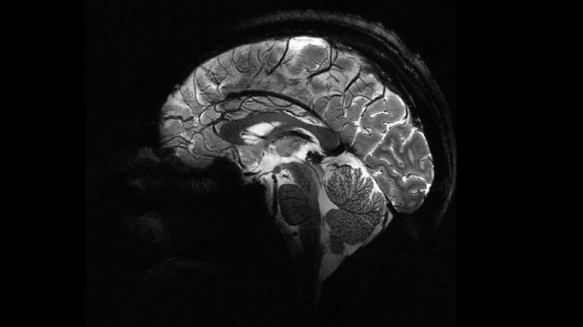 MRI agyi felvétel Alzheimer Parkinson
