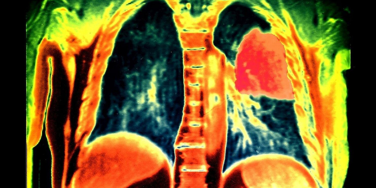 Rak płuca – tu widoczny w rezonansie czerwony guz w prawej górnej części zdjęcia