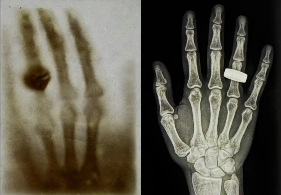 Prvi rendgenski snimak ljudske ruke ikad (L) i prvi rendgenski snimak ruke u svemiru snimljen tokom misije Fram2