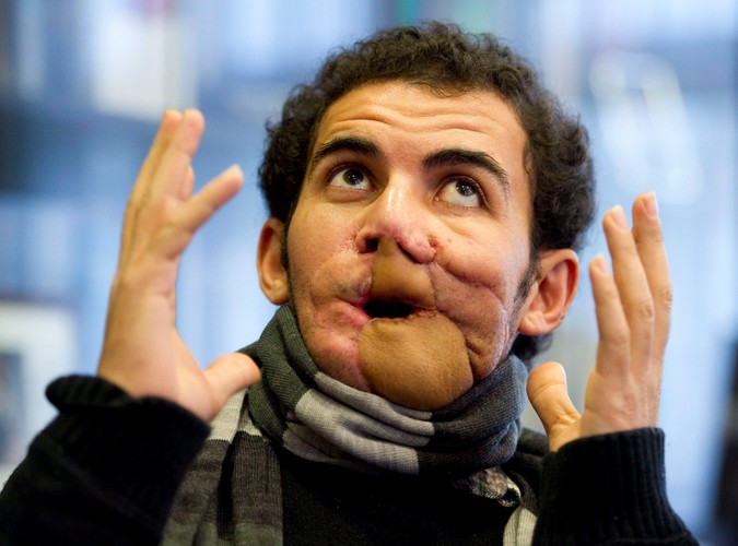 29-letni mężczyzna stracił szczękę. Połowa jego twarzy stała się krwawiącą miazgą. Nie mógł mówić, nie mógł samodzielnie jeść, był karmiony przez lekarzy, którzy wtłaczali mu pokarm bezpośrednio do żołądka. Do niemieckiego szpitala trafił dzięki staraniom pracowników organizacji charytatywnej.